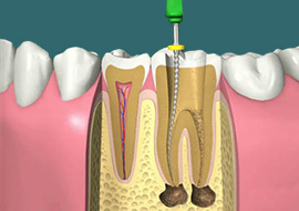 endodontie2