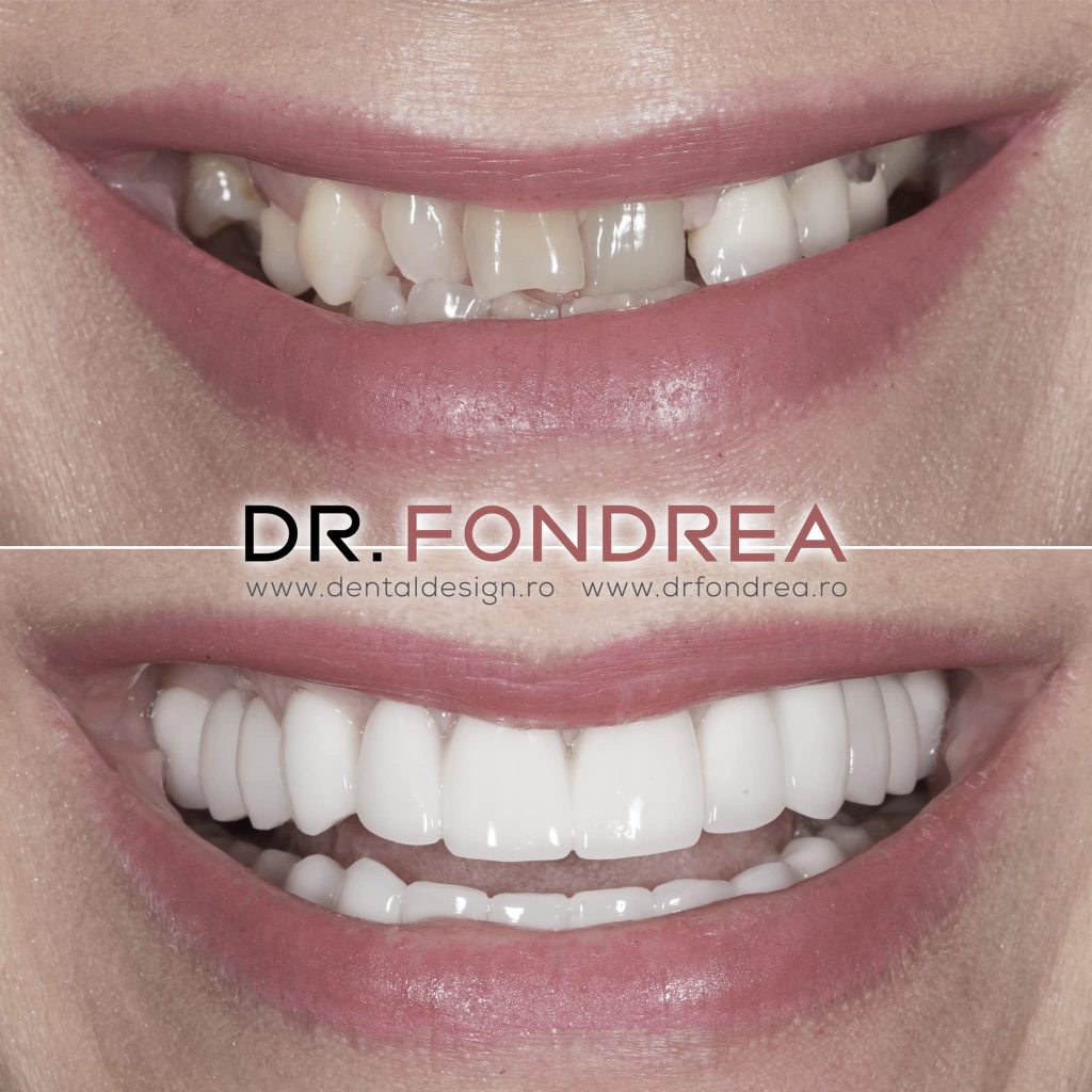 dantura fixa pe implanturi dentare, dini ficsi, dental design dr fondrea, timisoara
