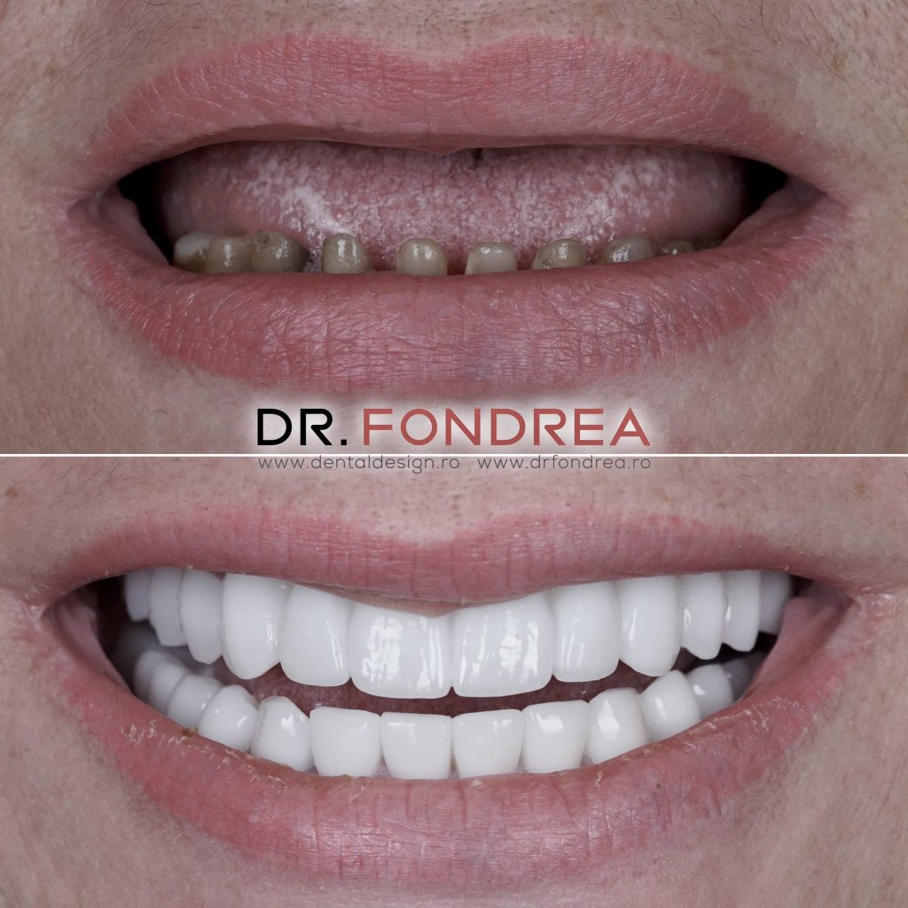 dantura fixa, dinti ficsi pe implanturi dentare, dental design timisoara, dr bogdan fondrea
