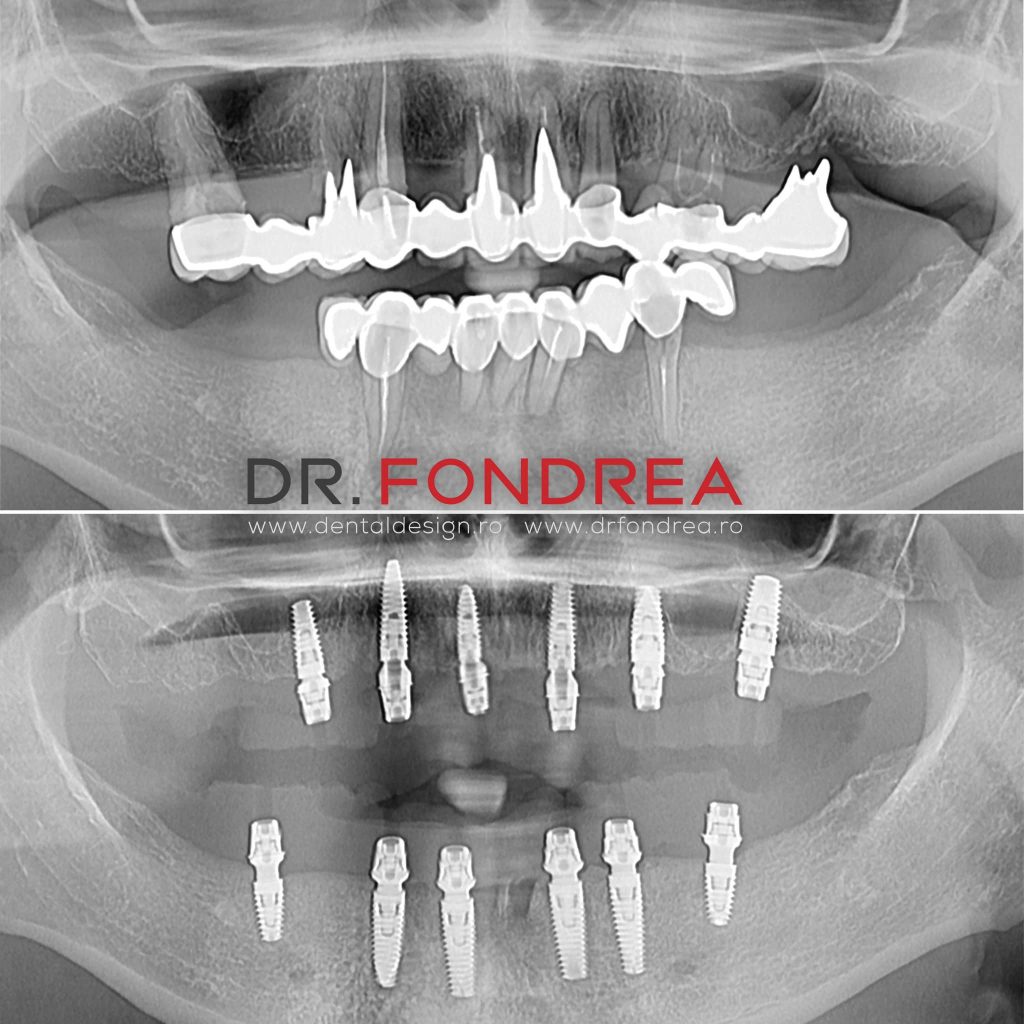inserare implanturi dentare, dental design timisoara, dr bogdan fondrea