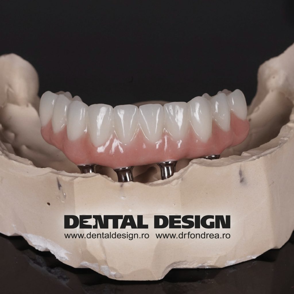 dinti ficsi pe implanturi dentare, dental design timisoara, dr fondrea bogdan