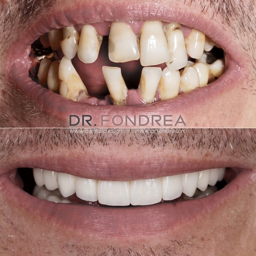 dantura fixa pe implanturi dentare, dinti ficsi, dental design timisoara, dr fondrea