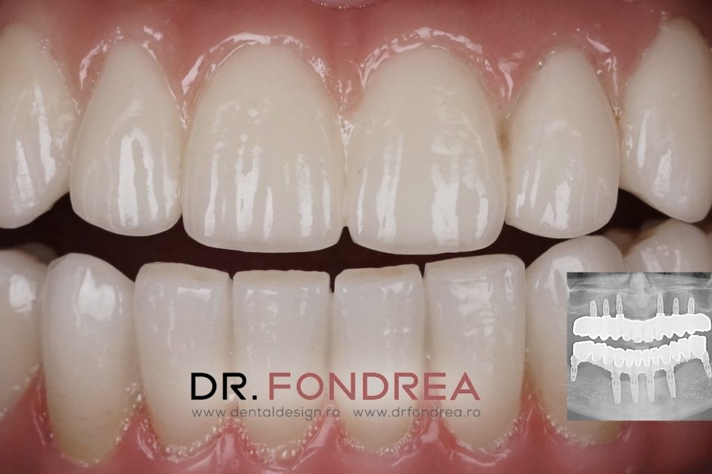 dantura fixa pe implanturi dentare, dental design timisoara, dr fondrea