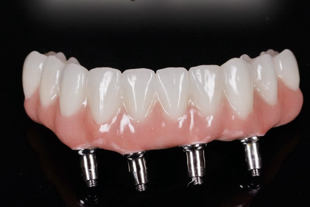 dinti ficsi, dantura fixa pe implanturi dentare, dental design timisoara, dr bogdan fondrea